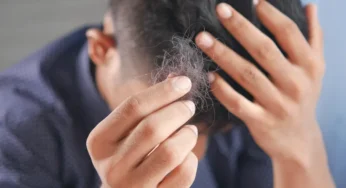 Cara Efektif Mencegah Kebotakan Dini: Tips untuk Menjaga Kesehatan Rambut