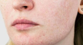 Tips Dokter Mengatasi Skin Barrier yang Rusak untuk Kulit Glowing