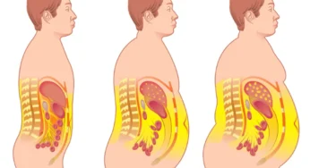 Bahaya Visceral Fat Kerap Diabaikan, Ini Faktanya