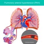 Hipertensi Paru: Penyakit Mematikan yang Sering Tak Disadari