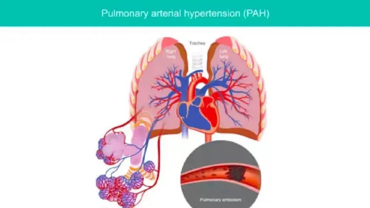 Hipertensi Paru: Penyakit Mematikan yang Sering Tak Disadari