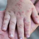 Dokter Muda di Cianjur Meninggal Akibat Campak, Kemenkes Imbau Waspada Penularan