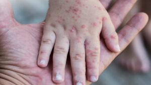 Dokter Muda di Cianjur Meninggal Akibat Campak, Kemenkes Imbau Waspada Penularan